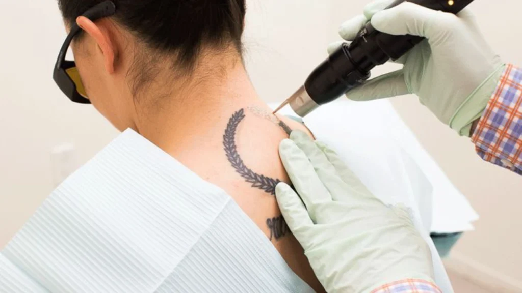 پاک کردن تتو با لیزر