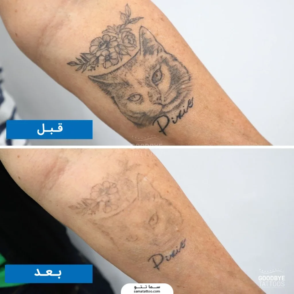 قبل و بعد تتو پاک شده با لیزر