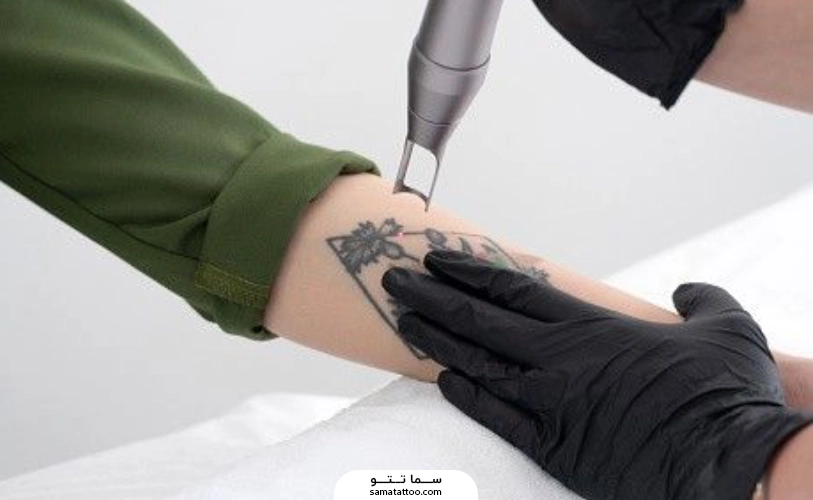 لیزر تتو دست