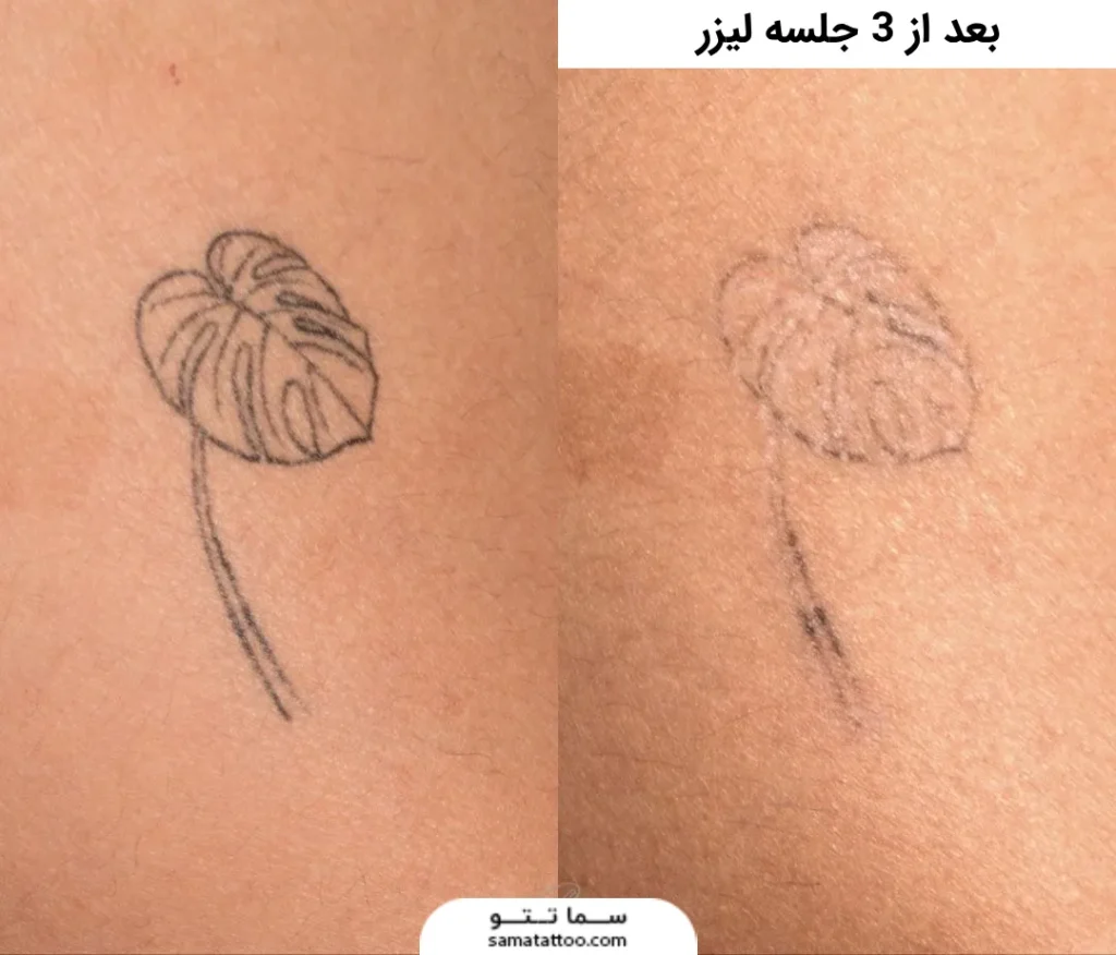 تتو برگ محو شده با لیزر