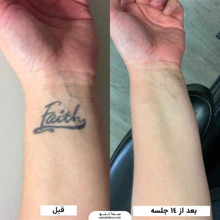 نمونه تتو پاک شده با لیزر