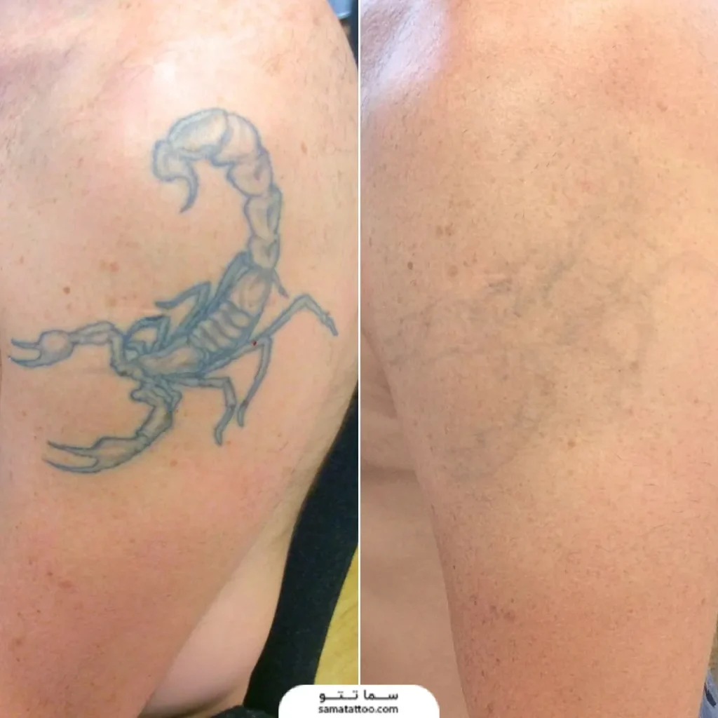 تتو عقر پاک شده با لیزر