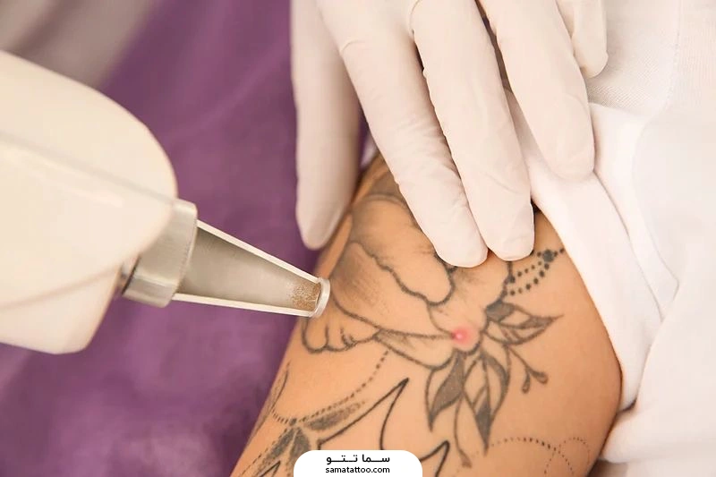 لیزر تتو دست برای پاک کردن تاتو