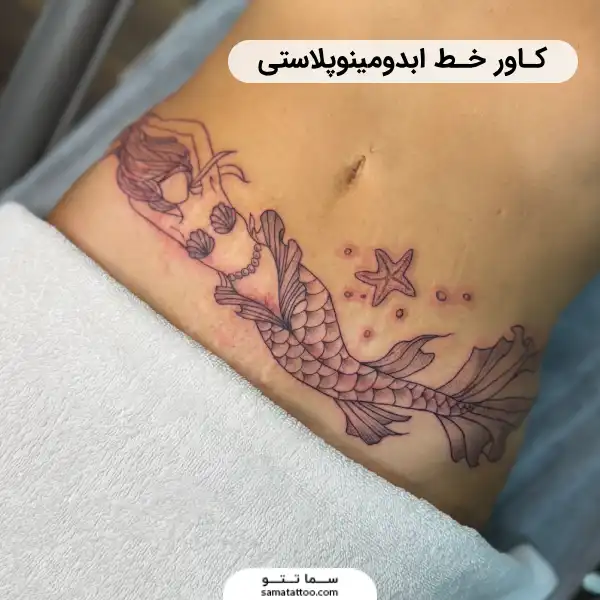 کاور بخیه ابدو