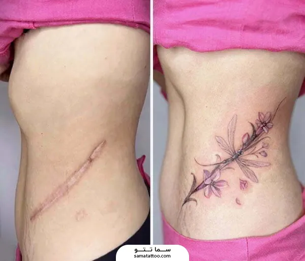 تاتو روی جای بخیه