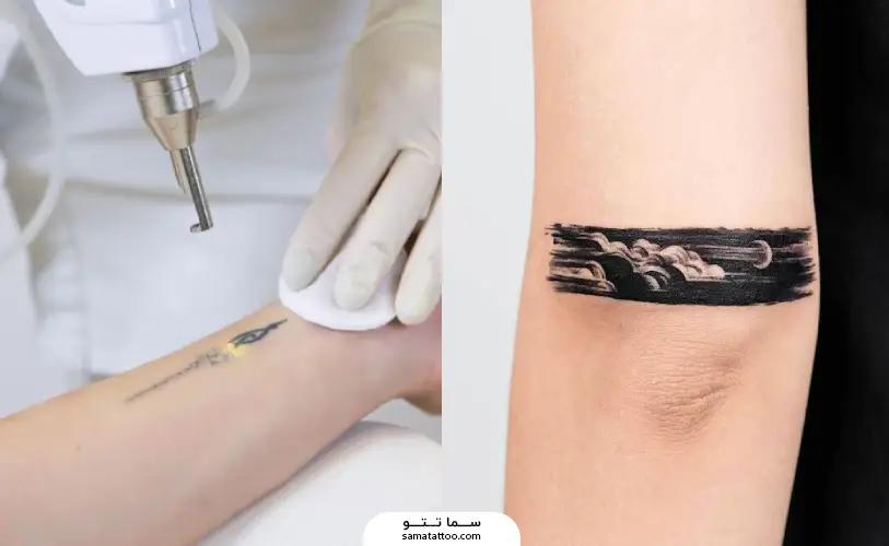 مقایسه کاور و لیزر تتو