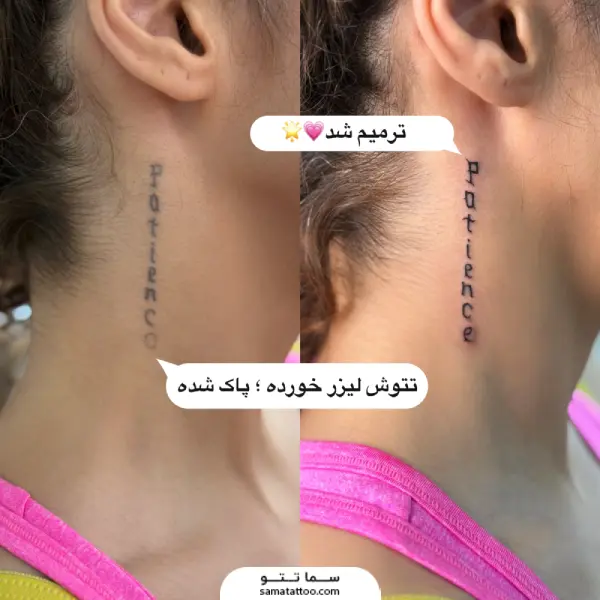 قبل و بعد ترمیم تاتویی که لیزر خورده بود