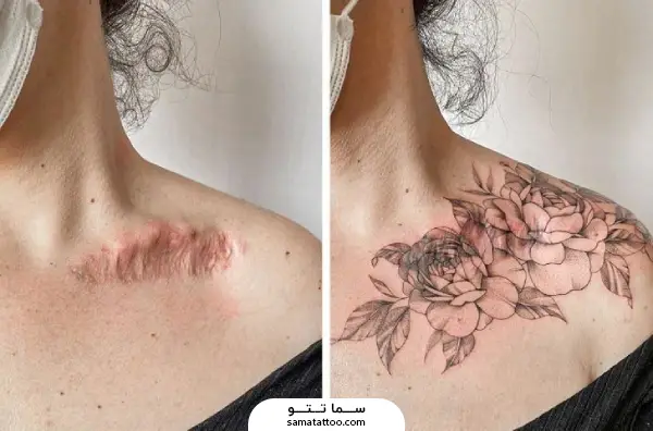 تتو گل روی جای سوختگی