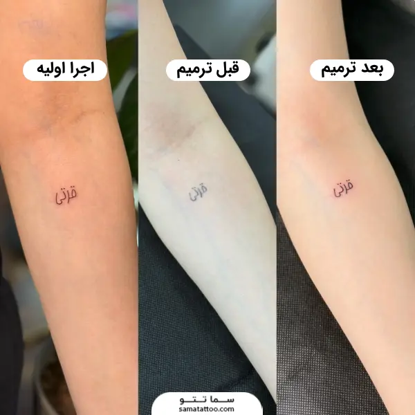 اجرای اولیه تاتو به همراه قبل و بعد ترمیم